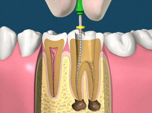 endodontia endodontia